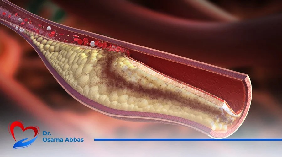 انسداد-الشريان-التاجي للشريان التاجي دور هام للغاية في حياة أي إنسان وهو توصيل الدم والأكسجين إلى عضلة القلب.إن أي قصور في الشريان التاجي يؤثر بالسلب على كفاءة القلب ويسبب الكثير من المشاكل والتي قد تؤدي في النهاية إلى الوفاة. معلومات عن الشريان التاجي إن هذا الشريان هو المسؤول الأول عن تغذية عضلة القلب بالدم والأكسجين، وتحيط الشرايين التاجية بعضلة القلب من الخارج ويتم تقسيمها على النحو التالي: الشريان التاجي الأيمن وهو المسؤول عن تغذية الجانب الأيمن من القلب، بجانب تغذية البطين الأيمن والأذين الأيمن. الشريان التاجي الأيسر وهو المسؤول عن تغذية الجانب الأيسر من القلب، بالإضافة إلى تغذية البطين الأيسر والأذين الأيسر. الشرايين التاجية الجانبية وهي شبكة من الأوعية الدموية تعمل في حالة ضيق أو انسداد أحد الشرايين التاجية أو انقطاع الدورة الدموية عن عضلة القلب، لتبدأ الشرايين بالعمل في هذه الحالة وإيصال الدم إلى عضلة القلب للحفاظ عليها. أعراض انسداد الشريان التاجي هناك العديد من الأعراض التي تشير للإصابة بانسداد الشريان التاجي ومنها: الشعور بألم في الصدر دون بذل أي مجهود القيء التعرق الشديد اضطرابات ضربات القلب بمجرد الشعور بـ أعراض انسداد الشريان التاجي، يجب التواصل فورًا مع الطبيب والانتقال للمستشفى من أجل تلقي العلاج المناسب، فكلما تلقى المريض العلاج مبكرًا زادت نسبة شفاءه. أسباب انسداد الشريان التاجي انسداد الشريان التاجي له العديد من الأسباب ومنها ما يلي: تاريخ عائلي سئ في أمراض القلب بشكل عام التدخين الارتفاع في ضغط الدم الإصابة بمرض السكري ومقاومة الأنسولين عدم ممارسة أي نشاط رياضي حتى ولو بشكل بسيط ارتفاع الكوليسترول في الدم الوزن الزائد (السمنة) العادات الغذائية الغير صحية كيف يتم تشخيص أمراض الشرايين التاجية؟ يوجد العديد من الوسائل التي يتم من خلالها تشخيص أمراض الشرايين التاجية: رسم القلب بالمجهود من خلال ممارسة المريض لجهد محسوب ومتابعة حالة ضغط الدم الموجات الصوتية على القلب والتي تعرف بمصطلح (الإيكو) ويتم استخدام هذا الصوت من الموجات، لتكوين صورة عن عضلة القلب، ليتمكن الطبيب من خلالها مشاهدة القلب أثناء عمله وتصوير النبض وعملية ضخ الدم. القسطرة التشخيصية وهي عبارة عن صبغة يتم حقنها في الشرايين التاجية لإظهار أي انسداد أو تجلطات. الأشعة المقطعية بالصبغة بحقن صبغة في الشرايين واللجوء للقسطرة التشخيصية عند وجود أي مشكلة. علاج أمراض الشرايين التاجية يختلف علاج مريض الشرايين التاجية من شخص لآخر، فالطبيب المختص هو الوحيد الذي يمكنه تحديد نوع العلاج الذي يحتاجه المريض على حسب كل حالة. طريقة العلاج الأولى: منح المريض أدوية دون أي تدخل جراحي إذا كان الانسداد بسيط في الشريان التاجي. طريقة العلاج الثانية: يلجأ الطبيب إلى تركيب دعامات عن طريق القسطرة لتوسيع الشريان من أجل مرور الدم بشكل طبيعي ووصوله إلى عضلة القلب في حالات الانسداد الشديد. طريقة العلاج الثالثة: في الحالات المتقدمة التي لم تستجب للدعامات قد يضطر الطبيب إلى عملية ترقيع الشرايين التاجية. نصائح مهمة لمرضى الشريان التاجي المتابعة مع الطبيب المعالج بصفة مستمرة لتقييم الحالة ومعرفة آخر المستجدات. الامتناع عن التدخين اتباع نظام غذائي صحي بمعرفة الطبيب المعالج ممارسة نشاط رياضي بسيط بشكل يومي عدم التعرض للانفعالات الشديدة أو بذل مجهود زائد ينصح الدكتور أسامة عباس مرضاه بأهمية التوجه إلى استشاري أمراض القلب والشرايين عند ملاحظة أي أعراض غير طبيعية لعلاج المشكلة مُبكرًا وتجنب الحاجة إلى إجراء الجراحة.
